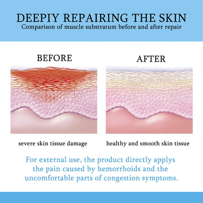 South Moon Hemorrhoids Cream ( BUY 1 GET 1 FREE )